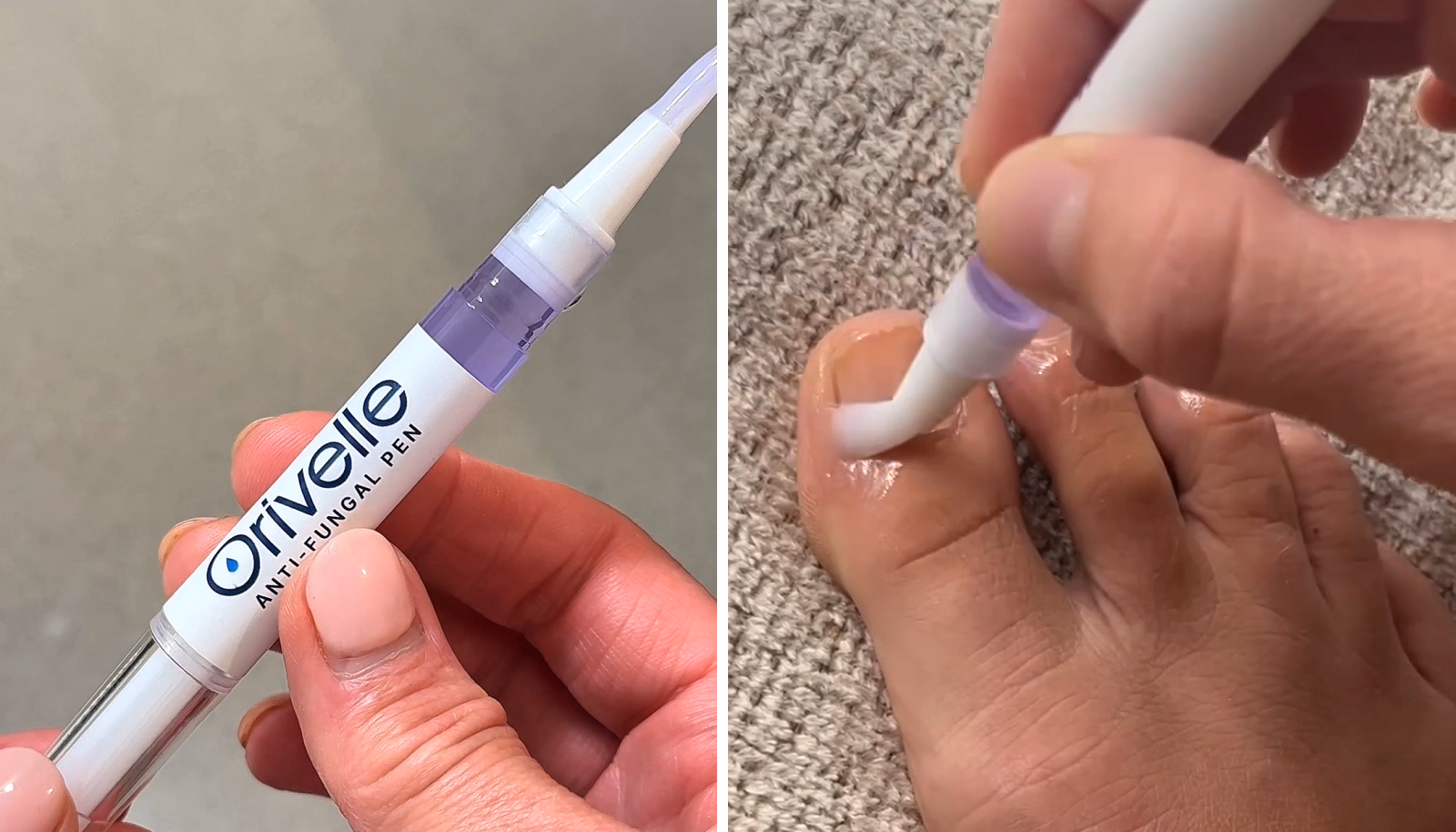 Orivelle pen close-up beside application to a toenail