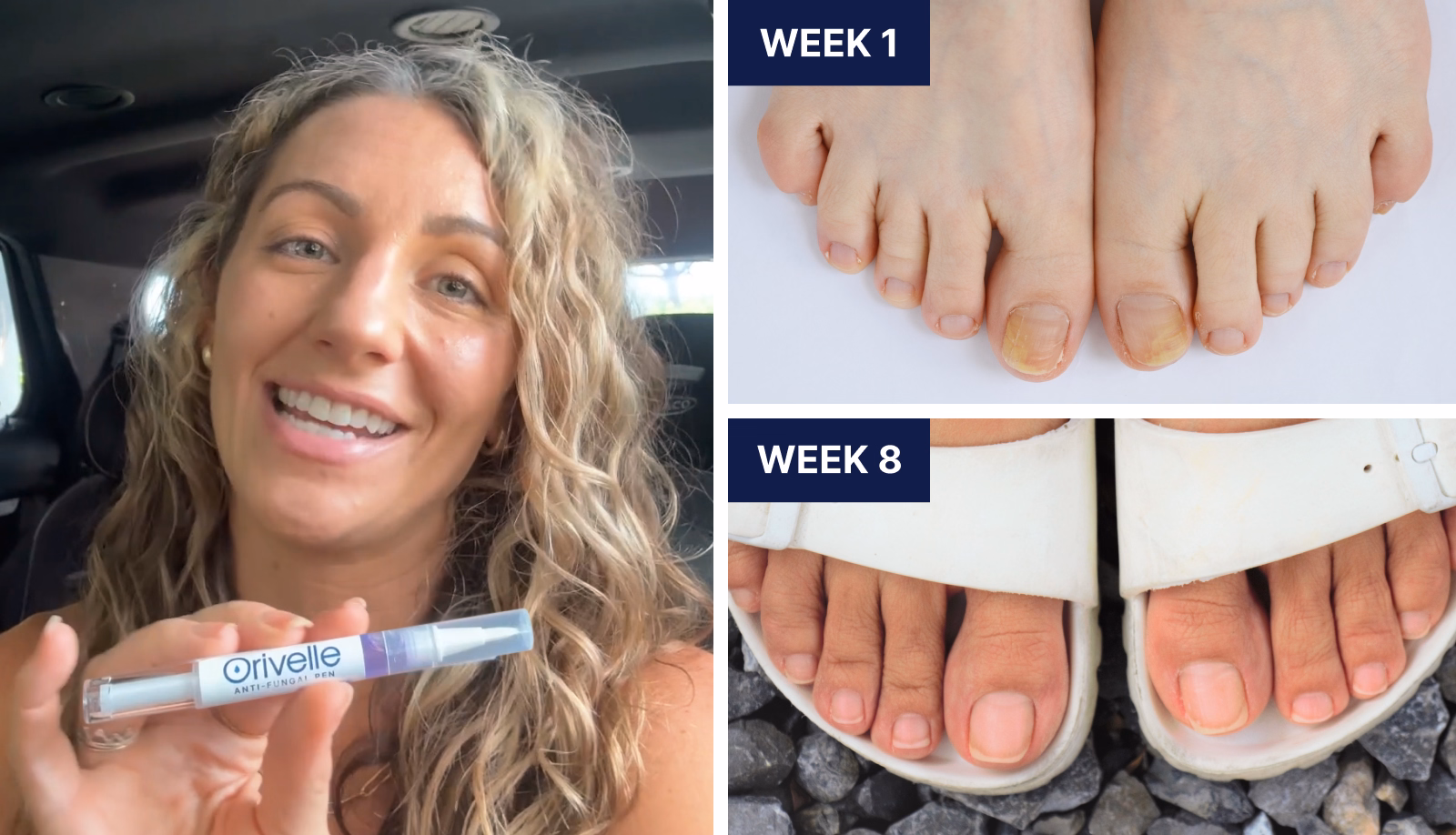Woman holding Orivelle beside Week 1 and Week 8 nail photos